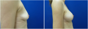 IP-breast-lift-mastopexy-revision-before-after-1-3