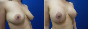 KN-breast-lift-mastopexy-revision-before-after-1-4