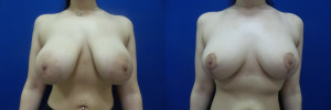 NT-breast-implants-augmentation-mastopexy-revision-before-after-1-1