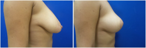 breast-lift-mastopexy-before-after-4-2
