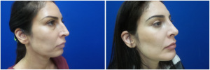 rhinoplasty-before-after-photo-12-2
